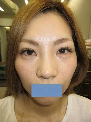 二重瞼（埋没法）の術後