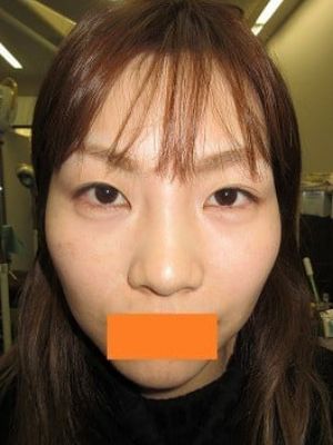 二重瞼（埋没法）の術前