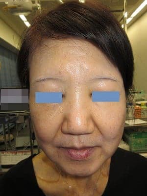 鼻翼縮小の術後