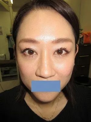 眼瞼下垂+上眼瞼タルミ取り+経結膜脱脂法の術後