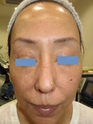 顔のイボの術後