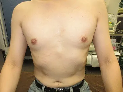 乳頭縮小（男性）の術後