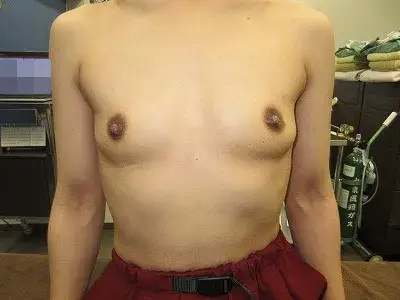 乳頭縮小（女性）の術後