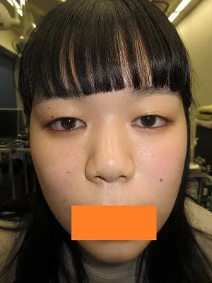 二重瞼（部分切開法）の術前