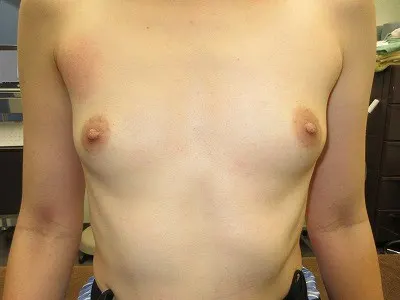 乳頭縮小（女性）の術後