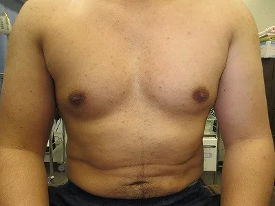 乳頭縮小（男性）の術後