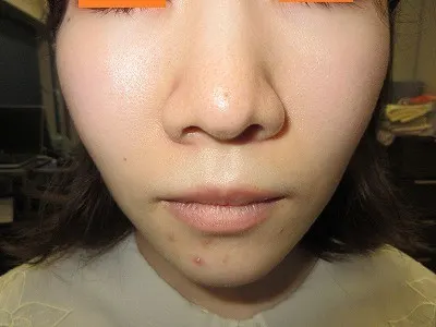 鼻翼縮小の術前