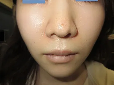 鼻翼縮小の術後