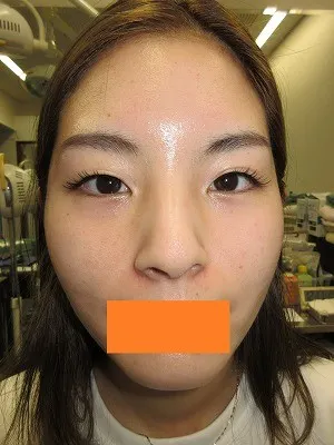 二重瞼（埋没法）の術前