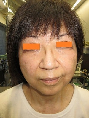 経結膜脱脂法（目の下のふくらみ取り）術前