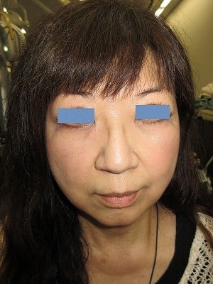 経結膜脱脂法（目の下のふくらみ取り）術後