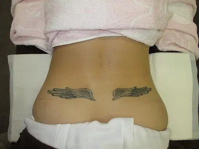 タトゥー（刺青）除去の術前