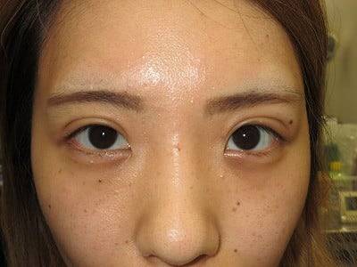 二重瞼（埋没法）の術後