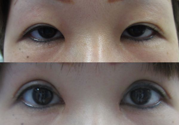 全切開二重まぶた、挙筋短縮（デカ目）併用例