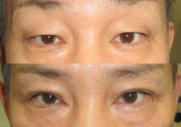 タルミ取り併用全切開二重まぶたの術前術後