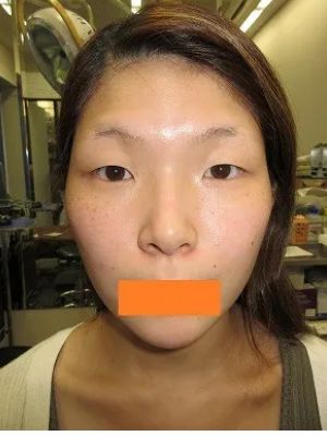 二重瞼（全切開法）の術前