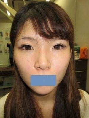 二重瞼（全切開法）の術後