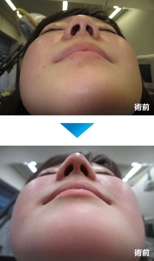 鼻尖形成の術前術後