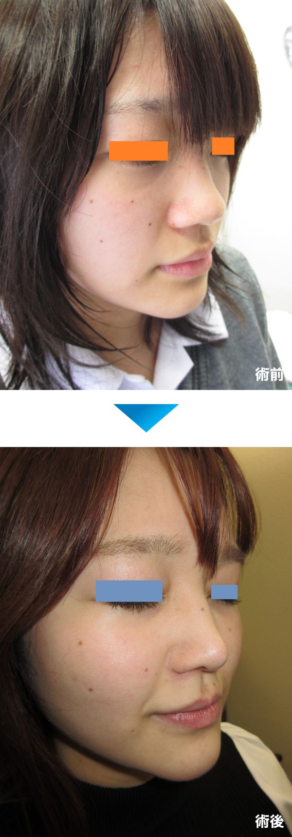 鼻尖形成の術前術後