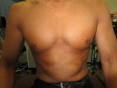 乳頭縮小（男性）の術前