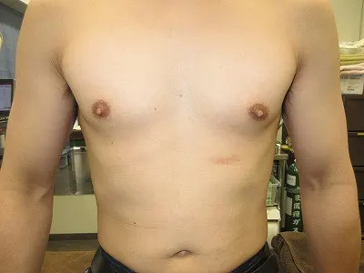 乳頭縮小（男性）の術前