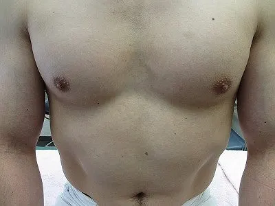 乳頭縮小（男性）の術前