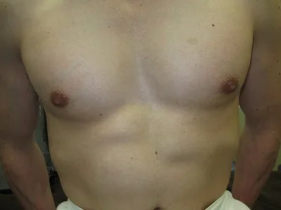 乳頭縮小（男性）の術後