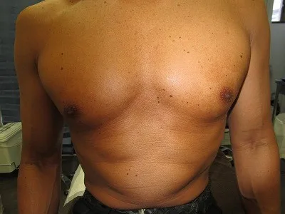 乳頭縮小（男性）の術後