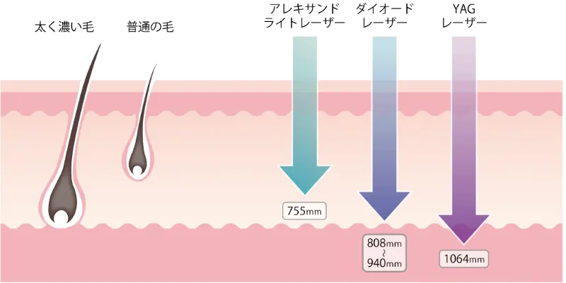 三輪皮フ科形成外科のジェントルマックスプロプラスのヤグレーザー
