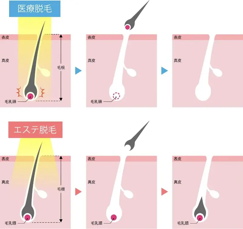 三輪皮フ科形成外科のジェントルマックスプロプラスのヤグレーザー