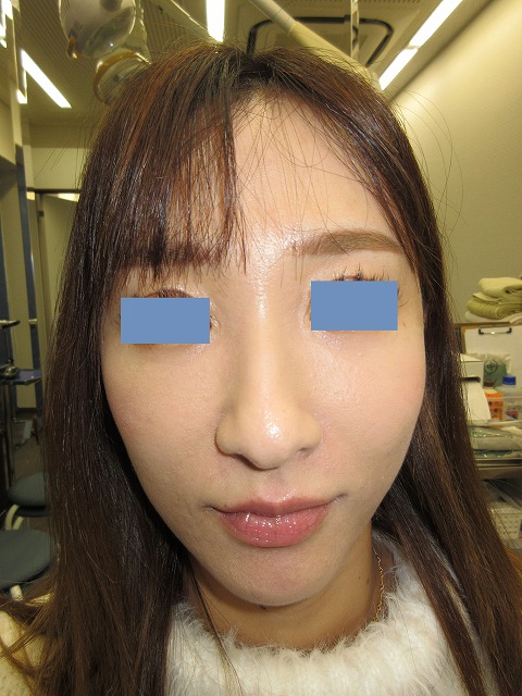 施注2か月後。正面。