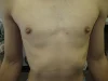 乳頭縮小（男性）の術前