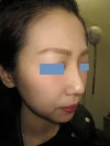 隆鼻術（ヒアルロン酸）の施注直後