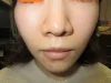 鼻翼縮小の術前