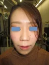鼻翼縮小の術後