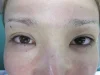 二重瞼（埋没法）の注射後