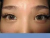 二重瞼（埋没法）の術後