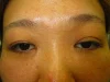 眼瞼下垂の術前