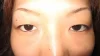 二重瞼（埋没法）の術前