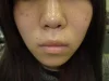 口唇拡大術の術前