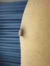 乳頭縮小（男性）の術前