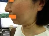 二重あごの治療（顎下の脂肪摘出術）の術前
