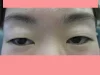 眼瞼下垂の術前