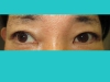 眼瞼下垂の術後