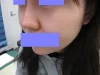 鼻翼縮小の術後