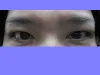 眼瞼下垂の術後