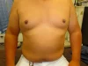 乳頭縮小（男性）の術後