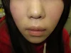 口唇拡大術の術後