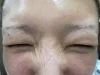 シワの注射後