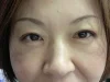二重瞼（部分切開法）の術後